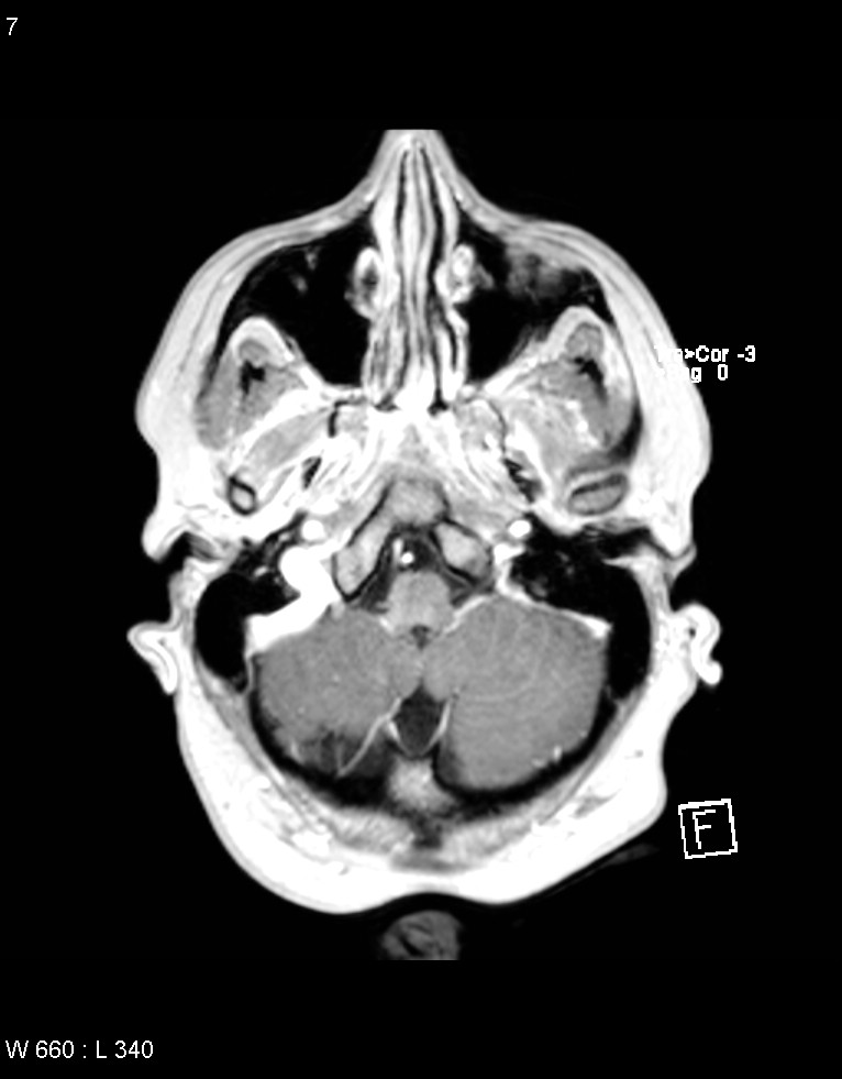 Astroblastoma (Radiopaedia 39792-42218 Axial T1 C+ 6).jpg