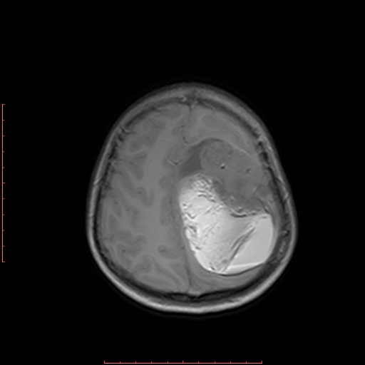 File:Astroblastoma (Radiopaedia 74287-85162 Axial T1 18).jpg