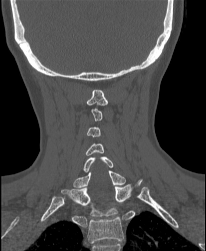 Atlanto-occipital assimilation with basilar invagination (Radiopaedia 70122-80188 Coronal bone window 172).jpg