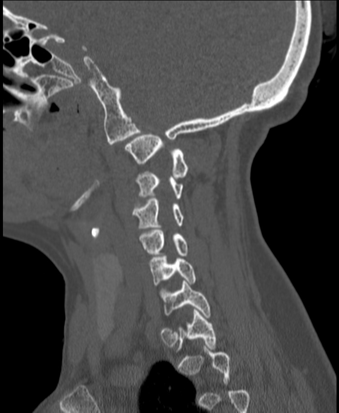 Atlanto-occipital assimilation with basilar invagination (Radiopaedia 70122-80188 Sagittal bone window 23).jpg