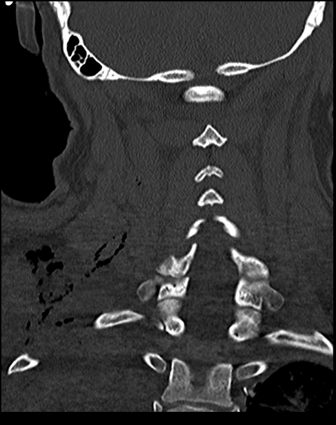 Atlanto-occipital dissociation - Traynelis type 1 (Radiopaedia 87570-103948 Coronal bone window 42).jpg