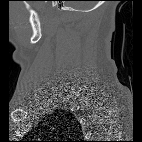 File:Atlanto-occipital dissociation injury (Radiopaedia 29274-29698 Sagittal bone window 48).png