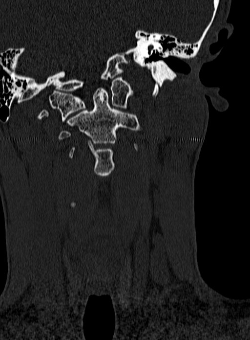 Atlantoaxial subluxation (Radiopaedia 44681-48450 Coronal bone window 21).jpg