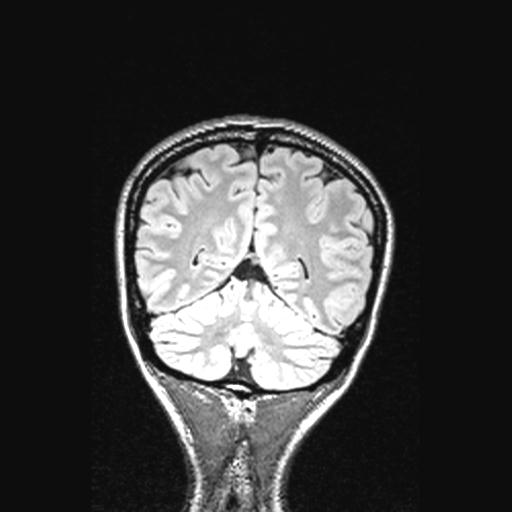 Atretic encephalocoele with inferior vermis hypoplasia (Radiopaedia 30443-31108 Coronal FLAIR 50).jpg