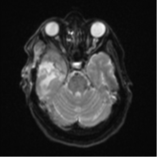 Atypical meningioma (WHO Grade II) (Radiopaedia 54742-60981 Axial DWI 9).png
