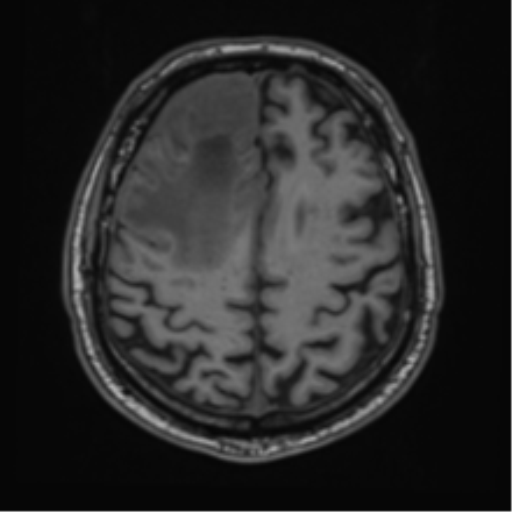 File:Atypical meningioma (WHO grade II) with brain invasion (Radiopaedia 57767-64729 Axial T1 38).png