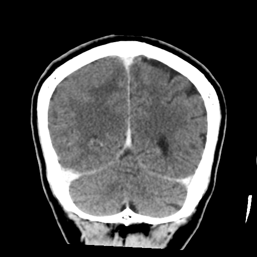 Atypical meningioma (WHO grade II) with osseous invasion (Radiopaedia 53654-59715 Coronal C+ delayed 46).png