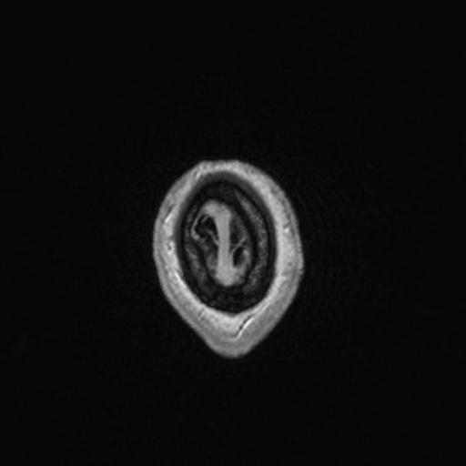 Atypical meningioma (grade II) - en plaque (Radiopaedia 29633-30147 Axial T1 C+ 171).jpg