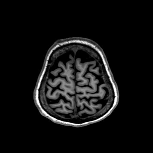 File:Autoimmune limbic encephalitis (Radiopaedia 30363-31005 T1 Axial 1mm 130).jpg
