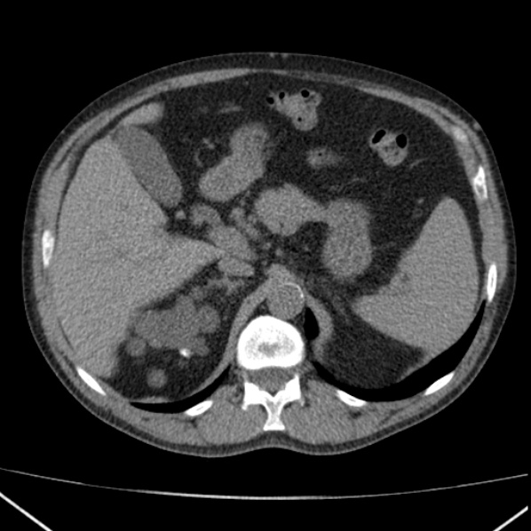 File:Autosomal dominant polycystic kidney disease (Radiopaedia 36539-38101 Axial non-contrast 23).jpg