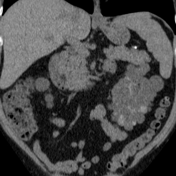 File:Autosomal dominant polycystic kidney disease (Radiopaedia 36539-38101 Coronal non-contrast 13).jpg