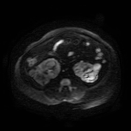 Autosomal dominant polycystic kidney disease (Radiopaedia 50259-55611 Axial DWI 101).jpg