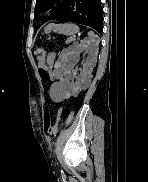 Autosomal dominant polycystic kidney disease (Radiopaedia 87830-104287 C 71).jpg