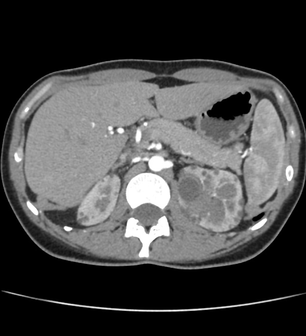 Autosomal dominant polycystic kidney disease - early onset (Radiopaedia 40734-43387 B 10).jpg