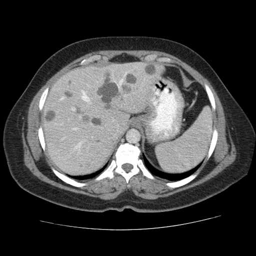Autosomal dominant polycystic kidney disease with hepatic involvement (Radiopaedia 32693-33662 B 13).jpg