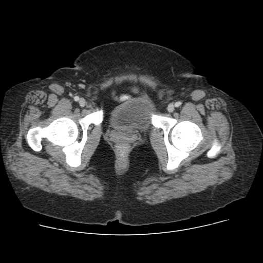 File:Autosomal dominant polycystic kidney disease with hepatic involvement (Radiopaedia 32693-33662 B 80).jpg