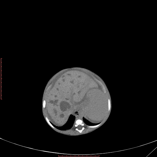 Autosomal recessive polycystic kidney disease associated with Caroli disease (Radiopaedia 61932-69984 Axial non-contrast 115).jpg