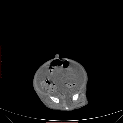 Autosomal recessive polycystic kidney disease associated with Caroli disease (Radiopaedia 61932-69984 Axial non-contrast 312).jpg