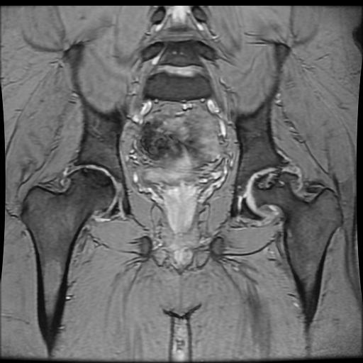 Avascular necrosis of the hip (Radiopaedia 61503-69465 F 57).jpg