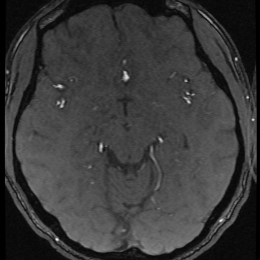 Azygos anterior cerebral artery (Radiopaedia 17059-16756 Axial MRA 34).jpg