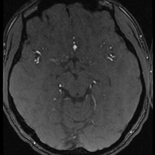 Azygos anterior cerebral artery (Radiopaedia 17059-16756 Axial MRA 36).jpg