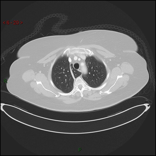 Azygos fissure and lobe (Radiopaedia 47620-52278 Axial lung window 20).jpg
