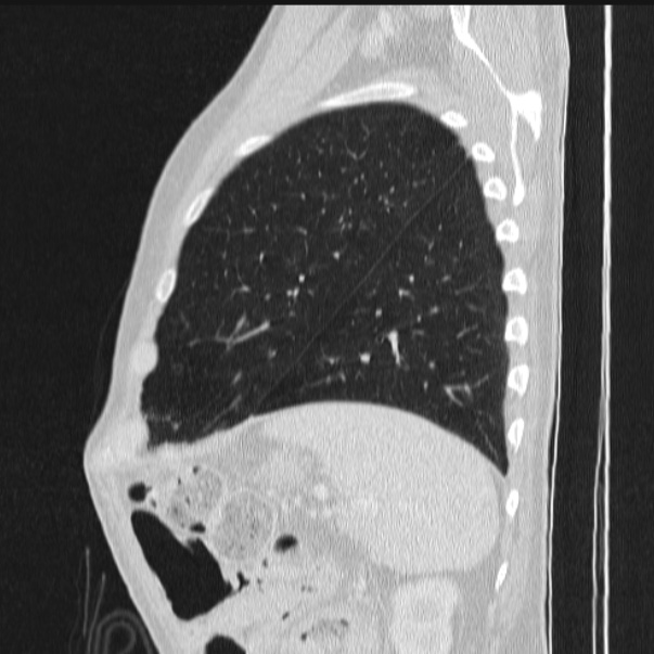 Azygos lobe (Radiopaedia 38259-40275 lung window 81).jpg