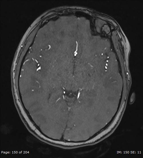 Balo concentric sclerosis (Radiopaedia 61637-69636 Axial MRA 150).jpg