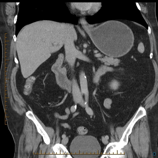 File:Bariatric balloon causing gastric outlet obstruction (Radiopaedia 54449-60672 B 31).jpg