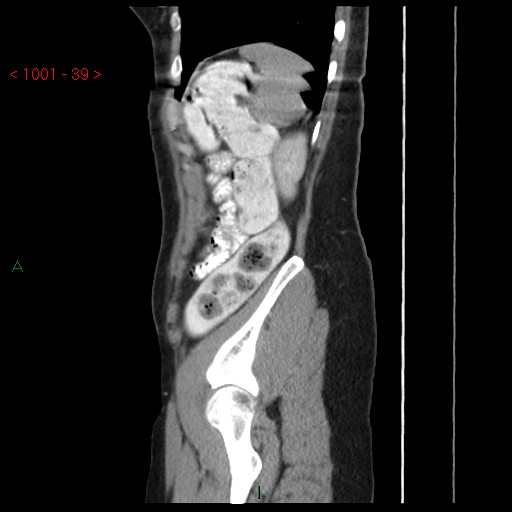 File:Bartholin gland cyst (Radiopaedia 54904-61181 Sagittal C+ delayed 39).jpg