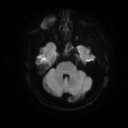 File:Basal cell carcinoma (periorbital) (Radiopaedia 55179-61559 Axial DWI 7).jpg