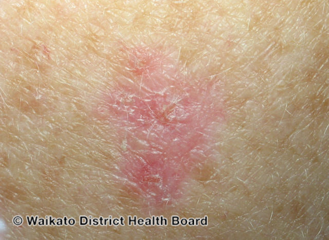 File:Basal cell carcinoma affecting the arms and legs 2 macro (DermNet NZ bcc-2-macro).jpg