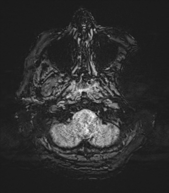 Basal ganglia metastasis (Radiopaedia 78928-91828 Axial SWI 6).png
