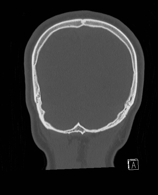 Base of skull fracture with bilateral Le Fort fractures (Radiopaedia 47094-51638 Coronal bone window 16).jpg