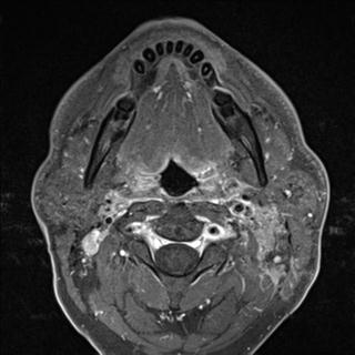 File:Base of tongue squamous cell carcinoma (Radiopaedia 31174-31884 Axial T1 C+ fat sat 21).jpg