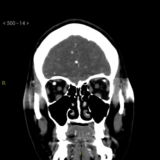 File:Basilar artery thrombosis (Radiopaedia 16260-15944 B 5).jpg