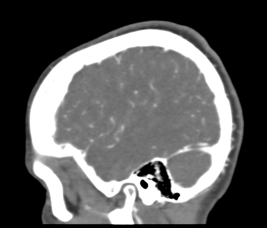Basilar tip aneurysm with coiling (Radiopaedia 53912-60086 C 112).jpg
