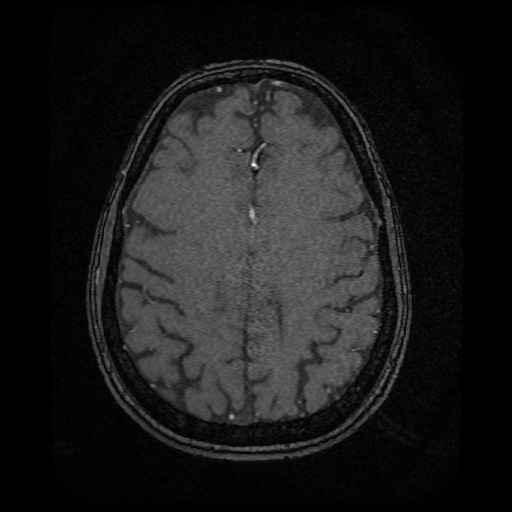 Basilar top and left middle cerebral artery aneurysm (Radiopaedia 61965-70031 Axial MRA 124).jpg