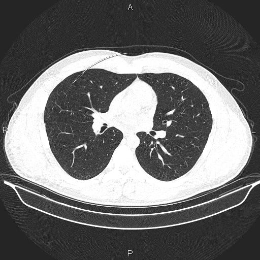 Beam hardening and ring artifacts (Radiopaedia 85323-100915 Axial lung window 39).jpg
