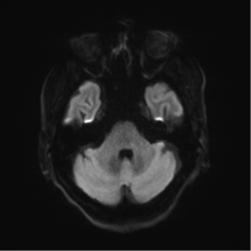 File:Behavioral variant frontotemporal dementia and late onset schizophrenia (Radiopaedia 52197-58083 Axial DTI Trace W 34).png