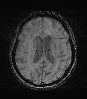 Behavioral variant frontotemporal dementia and late onset schizophrenia (Radiopaedia 52197-58083 Axial SWI 45).png