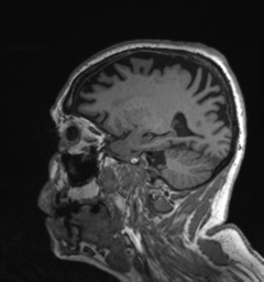 Behavioral variant frontotemporal dementia and late onset schizophrenia (Radiopaedia 52197-58083 Sagittal T1 25).png