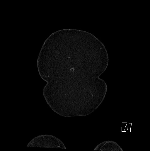 Below filter IVC thrombosis (Radiopaedia 58187-65266 B 15).jpg