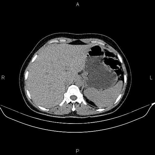 Benign adrenal adenoma (Radiopaedia 84166-99440 Axial non-contrast 19).jpg
