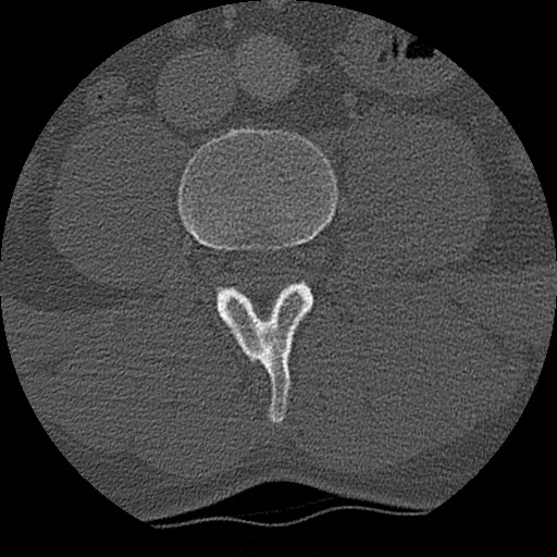 Benign post-traumatic pseudopneumoperitoneum (Radiopaedia 71199-81495 Axial bone window 243).jpg