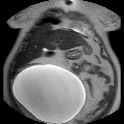 File:Benign seromucinous cystadenoma of the ovary (Radiopaedia 71065-81300 Coronal T2 14).jpg