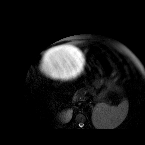 File:Benign seromucinous cystadenoma of the ovary (Radiopaedia 71065-81300 T2 SPAIR 35).jpg