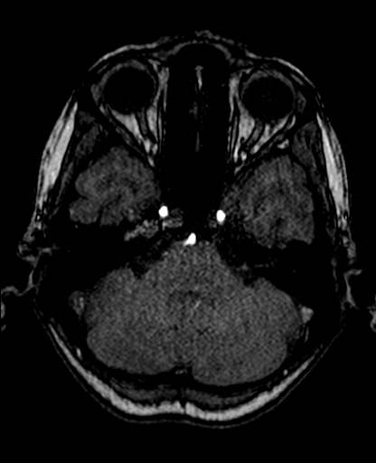 Berry aneurysm of the terminal internal carotid artery (Radiopaedia 88286-104918 Axial TOF 74).jpg