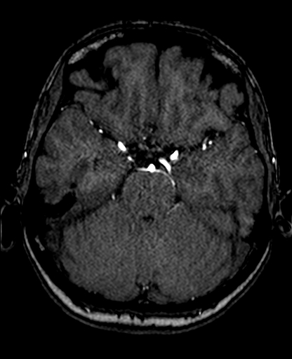 File:Berry aneurysm of the terminal internal carotid artery (Radiopaedia 88286-104918 Axial TOF 94).jpg