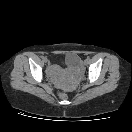 File:Bicornuate uterus- on MRI (Radiopaedia 49206-54296 Axial non-contrast 9).jpg